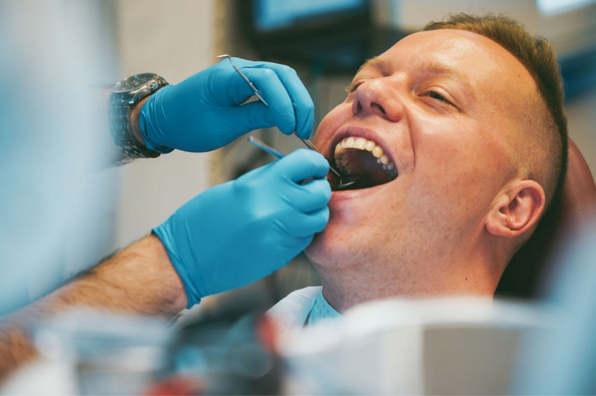 fogászati kezelések, fogkőeltávolítás