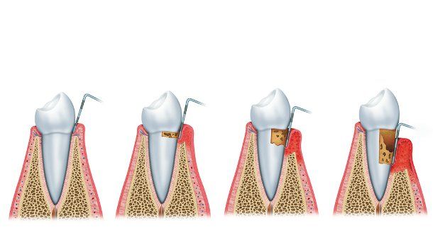 parodontolgógiai státusz